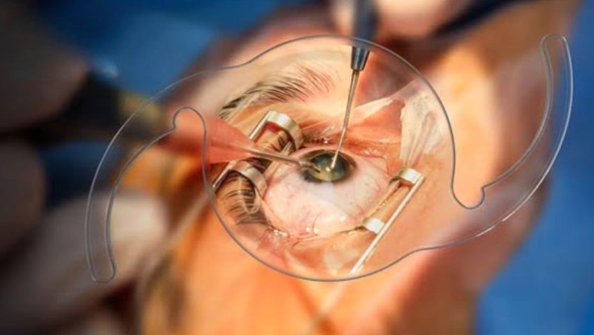 Cataract Eye Surgery